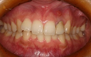 オールセラミッククラウン 術前