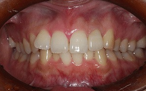 オールセラミッククラウン 術後