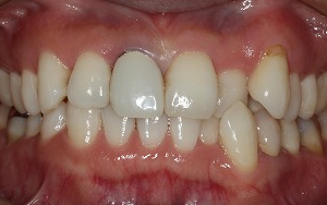 術前　エンプレスククラウン