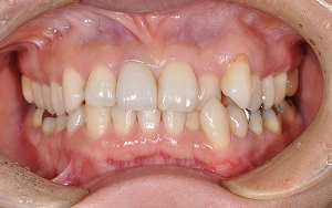 術後　エンプレスククラウン