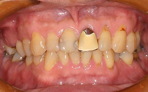 術前　全顎治療