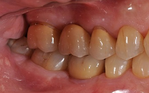 術後　全顎治療