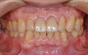 術後　全顎治療