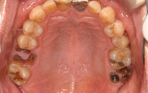 術前　全顎治療