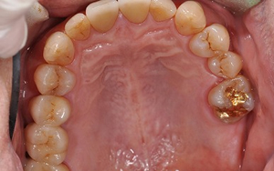 術後　全顎治療