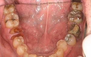 術前　全顎治療