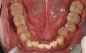 術後　全顎治療