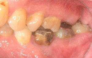 術前　全顎治療