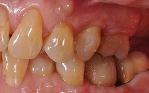 術後　全顎治療