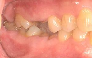 術前　全顎治療