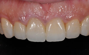 術後　ジルコニア