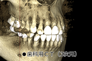 歯科用CT（3次元）