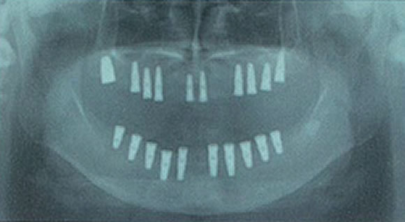 従来のインプラント治療法