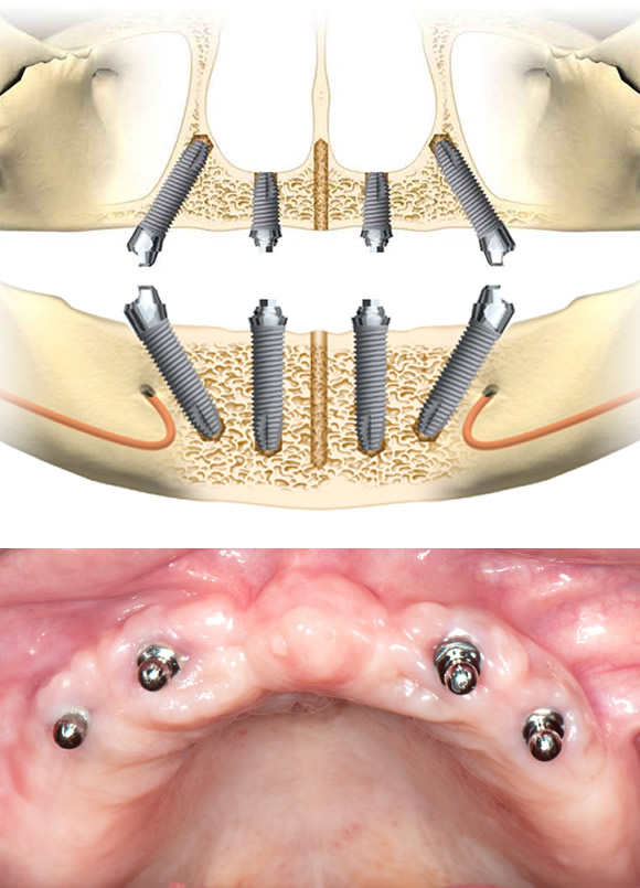 オールオンフォー（All-On-4） 1日で噛めるインプラント