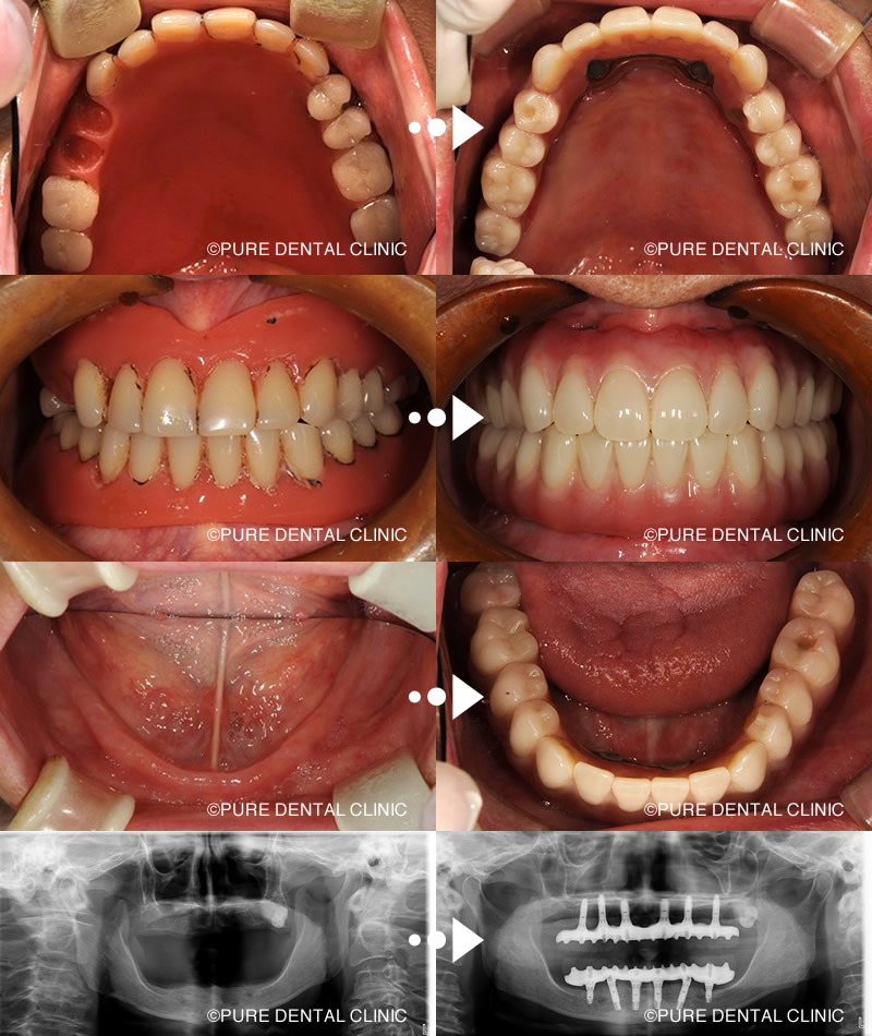 オールオン4インプラント | 熊本市
