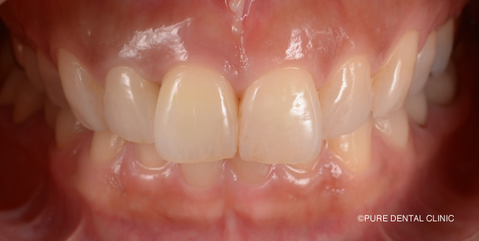 前歯の審美インプラント症例