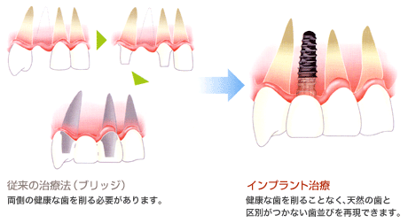 前歯を1本失った場合