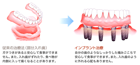 全ての歯を失った場合