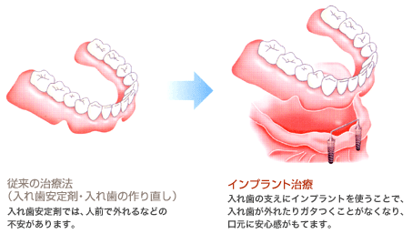総入れ歯を安定させるためのインプラント治療法