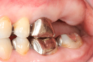 奥歯のインプラント症例