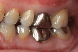 奥歯のインプラント症例