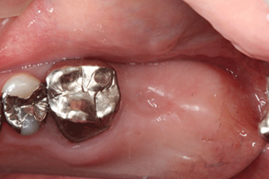 奥歯のインプラント症例