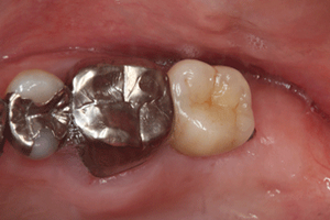 奥歯のインプラント症例