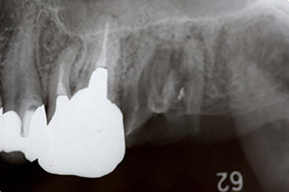 ソケットリフト