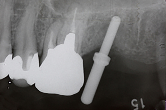 ソケットリフト