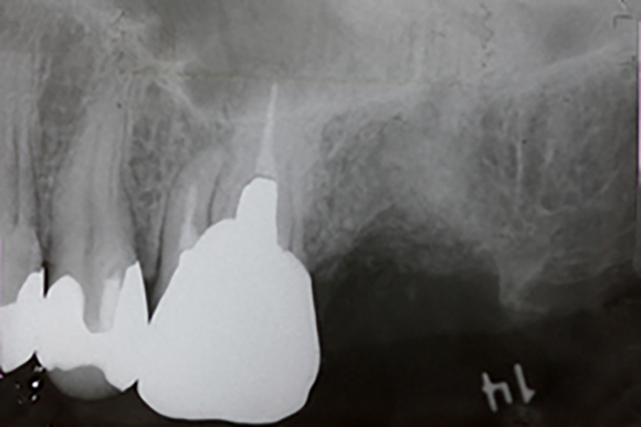 ソケットリフト