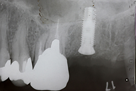 ソケットリフト