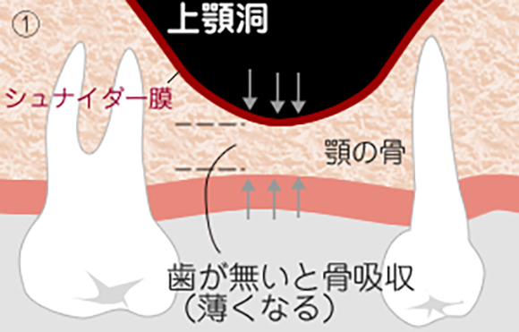 ソケットリフト1