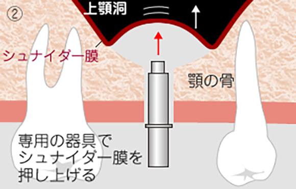 ソケットリフト2
