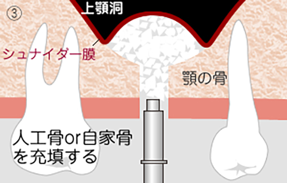 ソケットリフト3