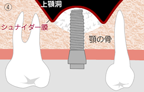 ソケットリフト4