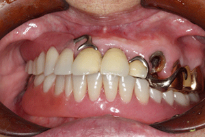 インプラントで固定する入れ歯の症例