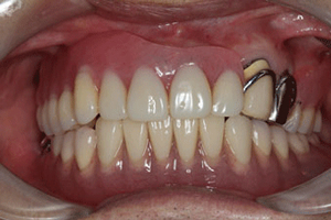インプラントで固定する入れ歯の症例