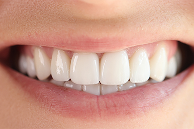 ホワイトニング