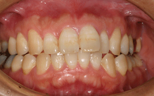 ホワイトニング 術前