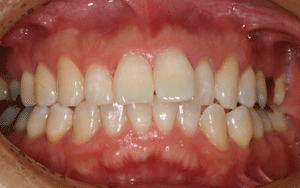 ホワイトニング 術後