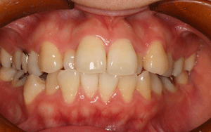 ホワイトニング 術前