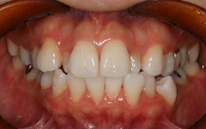 ホワイトニング 術後